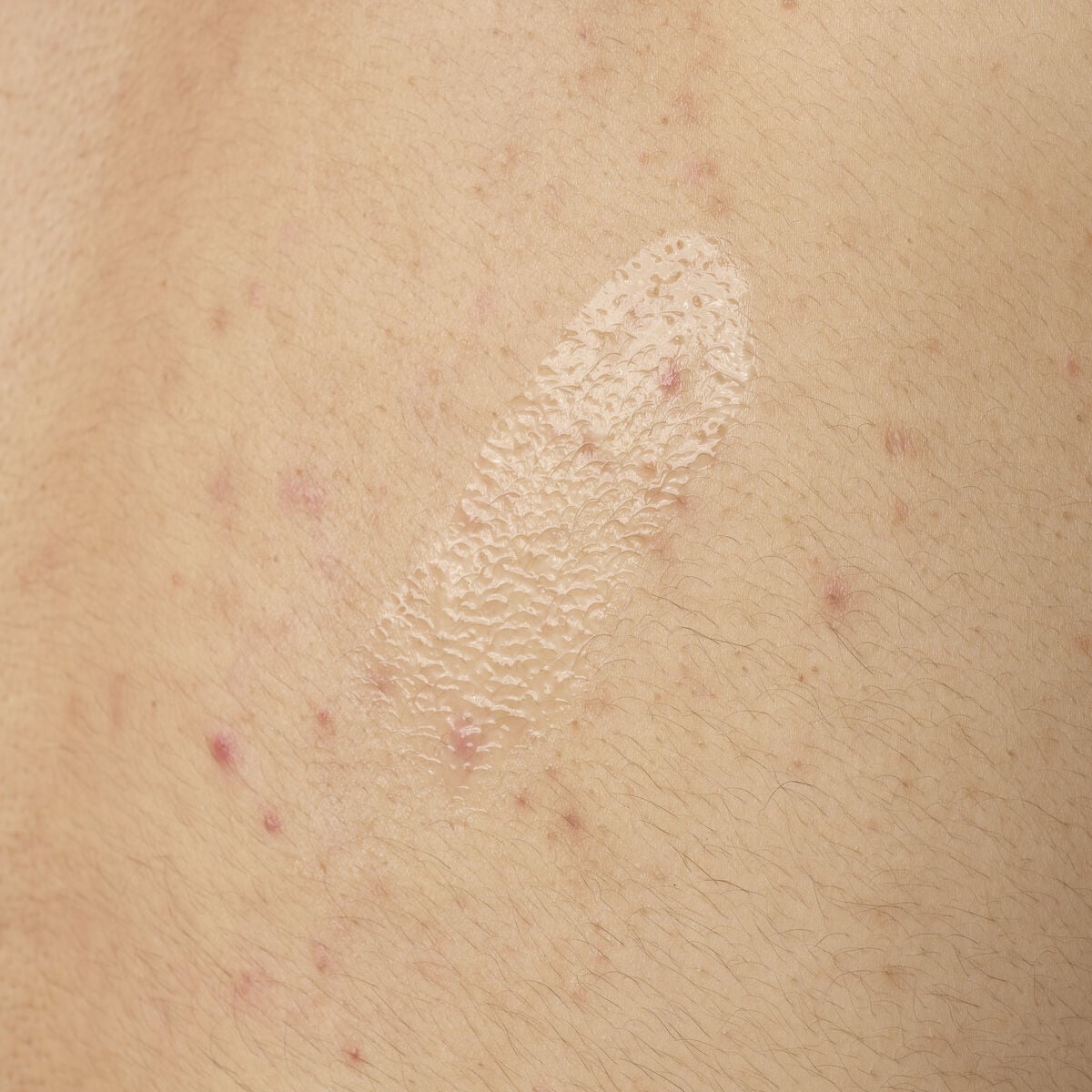 salicylic-acid-0-5-body-serum-a8 ORD-salicylic-acid-05-body-240ml-application.jpg