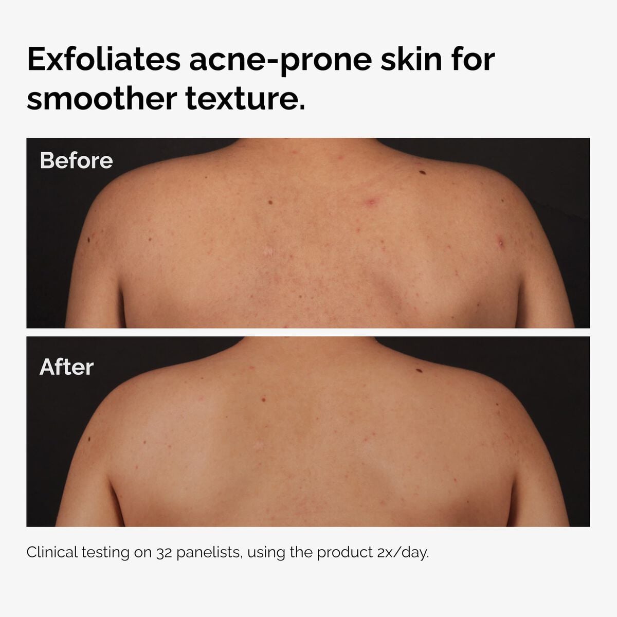 salicylic-acid-0-5-body-serum-a8 ord-salicylic-acid-body-serum-before-after-graphic-NA.jpg