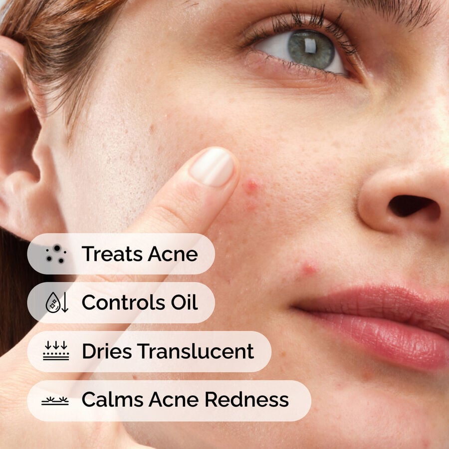 sulfur-10-powder-to-cream-concentrate-p4 ord-sulfur-10pct-powder-to-cream-concentrate-model-application-with-benefits-acne.jpg